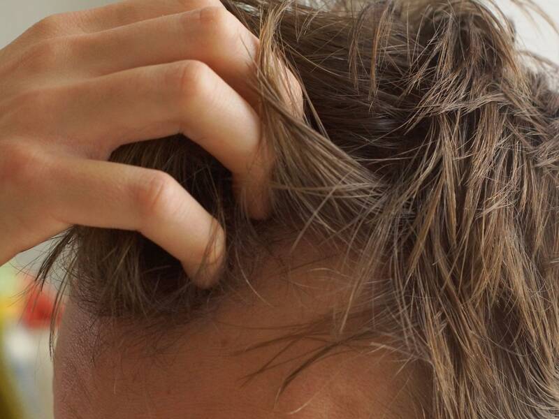 Skæl i hovedbunden – vælg den rigtige løsning