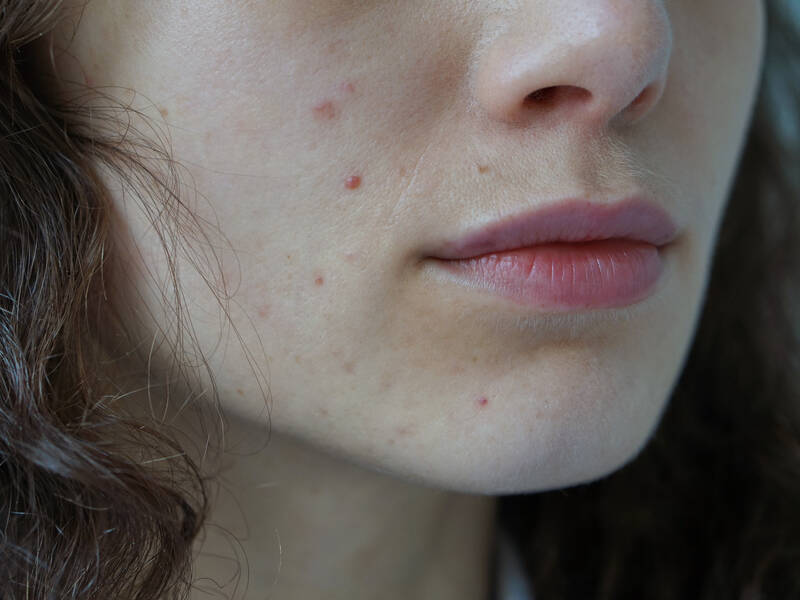 A-DERMA: Hudplejerutinen mod bumser og hudorme